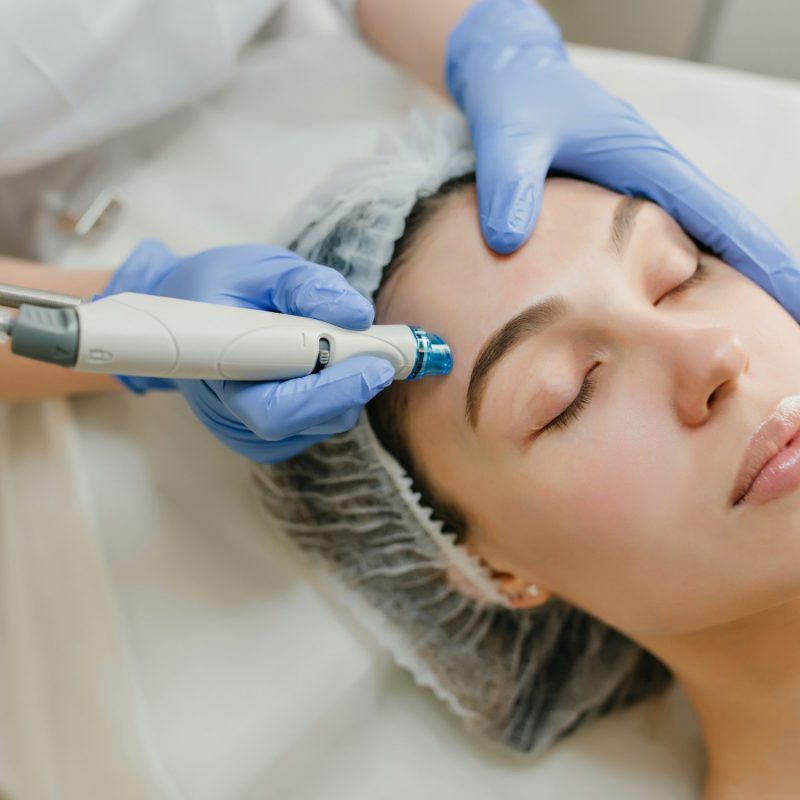 A practitioner working across a patient's forehead with a skin-resurfacing handpiece